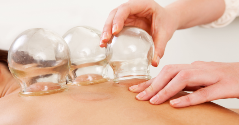 Traditional Chinese Medicine (TCM) Cupping in Singapore: A Comprehensive Guide to Its Benefits, Techniques, and What to Expect